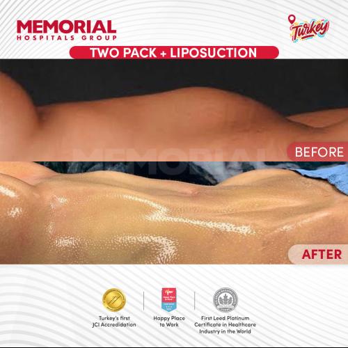 Abdominal Etching Photo avant/après